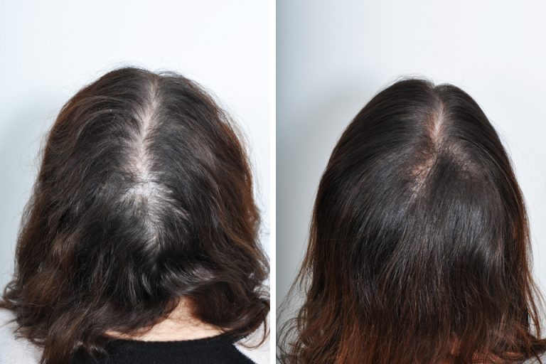 Hair-Restoration-45.jpeg